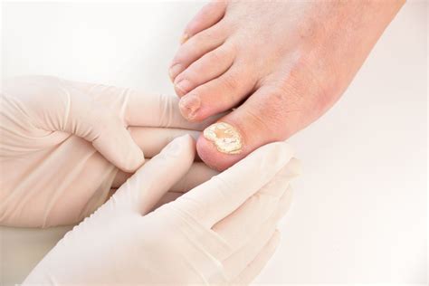 Tinea Unguium: Symptoms, Causes, Diagnosis, Treatment