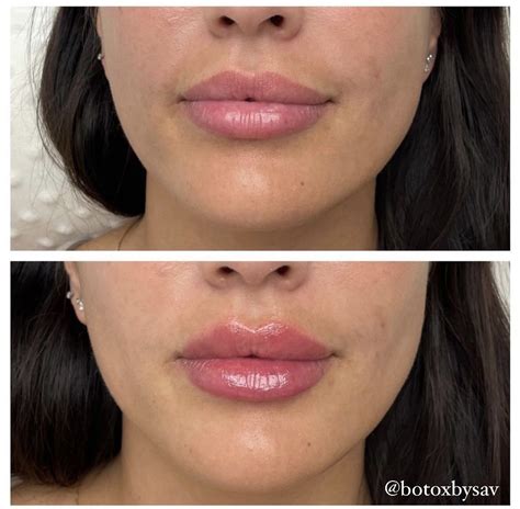 Lip Filler Before and After in 2022 | Lip fillers, Restylane, Lips