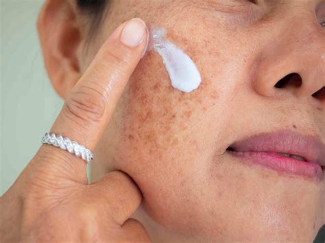 What You Need To Know About Melasma | Victorian Dermal Institute