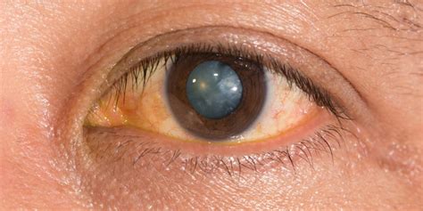 Nuclear Sclerotic Cataract: Signs, Causes, Treatment Options