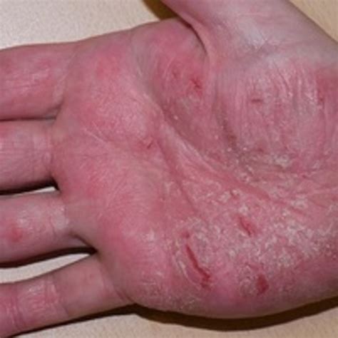 Palm Skin Rash Types Causes Pictures Treatment Health - vrogue.co
