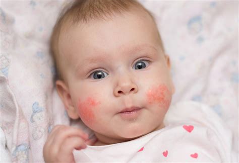 What can cause Eczema? - Dr. Ana-Maria Temple