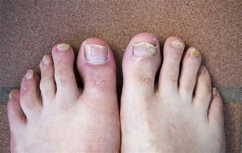 All You Need to Know About Fungal Nails - Farnham Foot Clinic