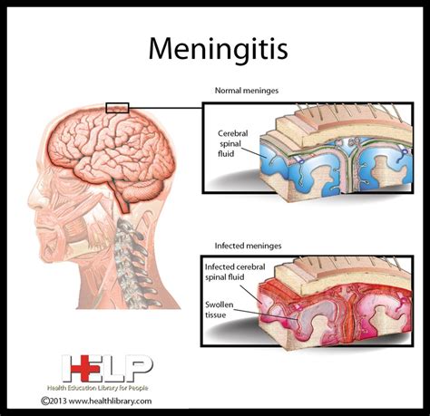 Meningitis