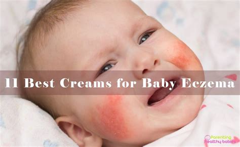 Baby Face Cream Eczema at Daniel Harris blog