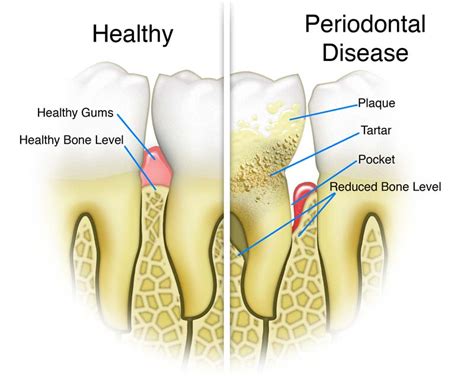 Periodontal Disease (Gum Disease) | Bright Smiles Dental Care