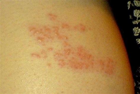Do I Have Shingles? Symptoms, Causes and Natural Remedies for Shingles (Herpes Zoster Virus ...