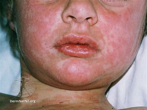 Measles | KidsHealth NZ