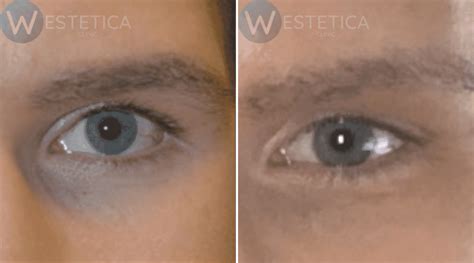 Almond Eye Aesthetics - Westetica Clinic