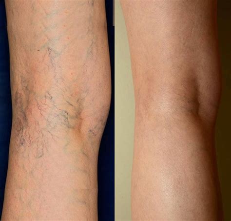 Laser Thread Vein Removal - Spider Vein Removal - Skin House Luton