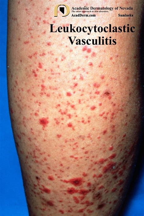 Leukocytoclastic Vasculitis: Small-Vessel Vasculitis... - Academic Dermatology of Nevada