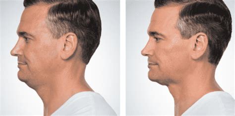 Loosen Your Tie: Kybella for Men | Usha Rajagopal, MD