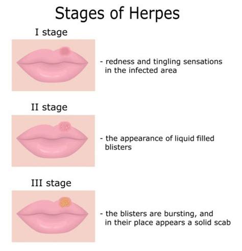 Herpes (Herpes Simplex) - Symptoms, Treatment | STD Herpes