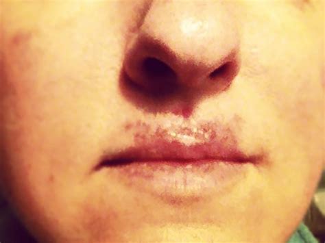 Skin Cancer On Upper Lip - vrogue.co