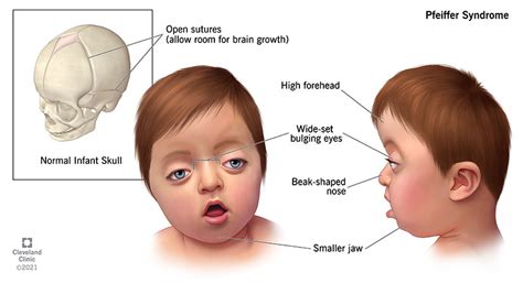 Pfeiffer Syndrome: Symptoms, Causes, Diagnosis, Treatment