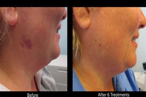 Laser Birthmark Removal: Procedure, Side Effects And Costs (Before & After Pics)