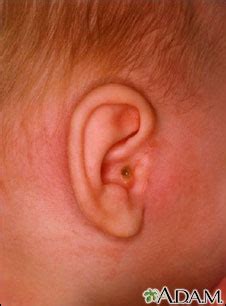 Mastoiditis - side view of head: MedlinePlus Medical Encyclopedia Image