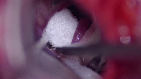 Right hemifacial spasm - MVD - Microvascular decompression - YouTube