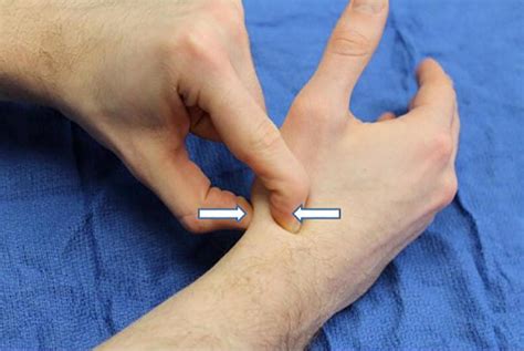 Occult Scaphoid Fractures | Anesthesia Key