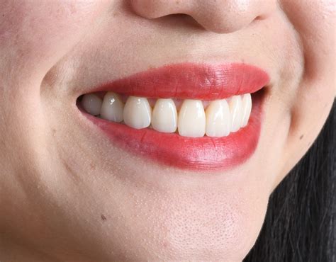 What Does A Tooth Veneer Look Like