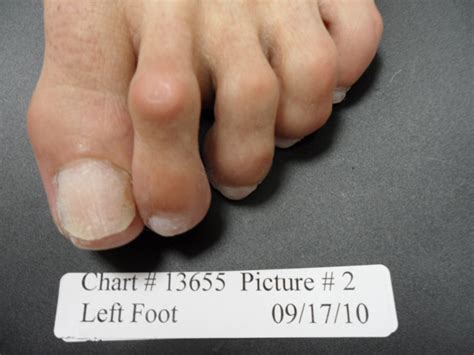 Fungal Nail Patient - 13655 - Country Foot Care