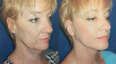 How Long is Recovery from an Eyelid Lift? | Wall Township Eyelid Lift | Karolak Plastic Surgery ...