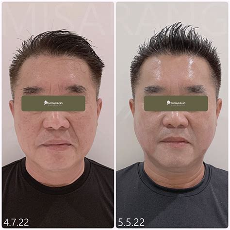 InMode Skin Tightening Treatment | Los Angeles Skin Care Clinic