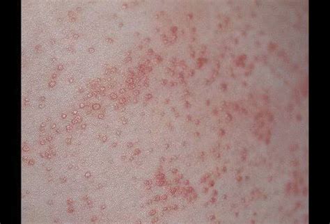 Miliaria rubra or prickly heat or sweat rash - MEDizzy