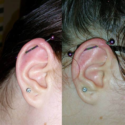 Infected Ear Cartilage Piercing