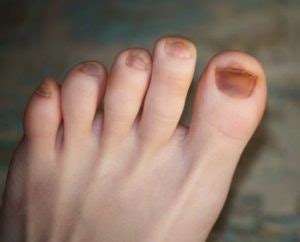 Discolored Toenails - Causes, Treatment and Home Remedies