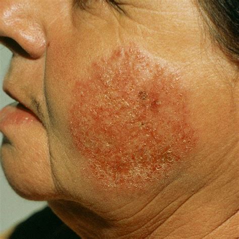 Eczema on the Face: Symptoms, Causes, Treatment and Prevention