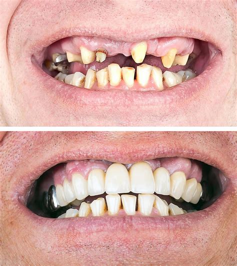 Dental Bridge - Procedure, Dental Bridge Vs Dental Implant