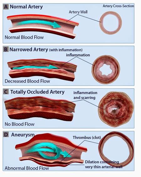 Vasculitis | Blood Inflammation Disorder | PharmaSchool