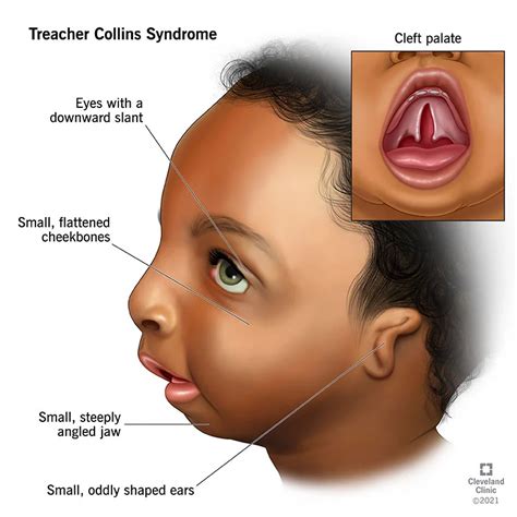 Treacher Collins syndrome | DentMistry