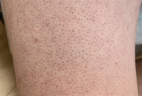 WHAT IS KERATOSIS PILARIS: SYMPTOMS, CAUSES, DIAGNOSIS, AND MORE