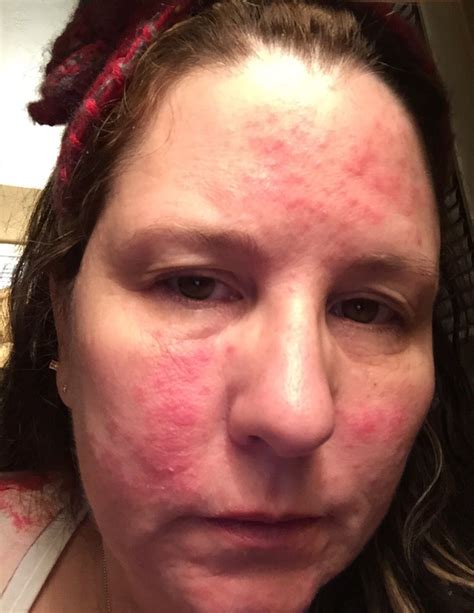 Lupus butterfly rash ? Or is this rosacea? | Lupus rash, Skin disorders ...
