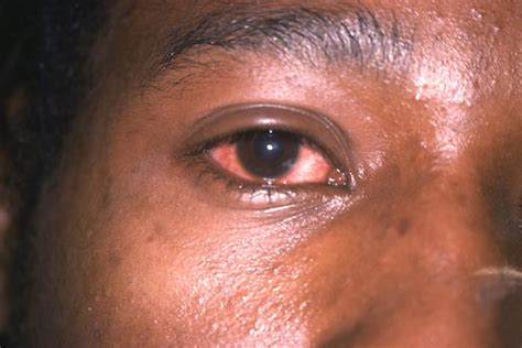 Gonorrhea Eye Treatment