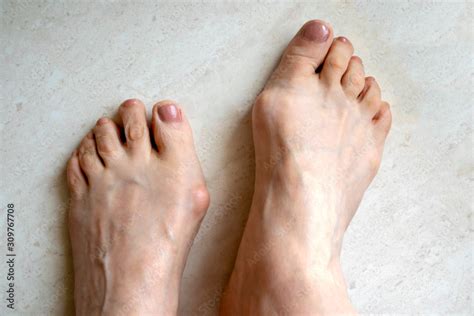 Hallux valgus, big abnormal feet bones. Bunion on big toes of female ...