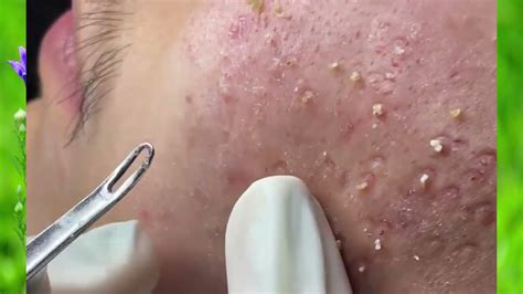 cystic acne removal,loan nguyen,blackheads 2022,pimple popping,acne extraction ,blackhead ...