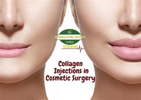 Collagen injections on the forefront of cosmetic plastic surgery – The ...