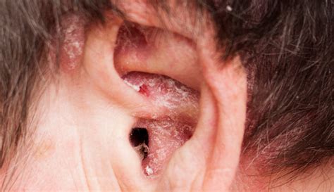 What Does Eczema in the Ear Look Like? - Infrared for Health