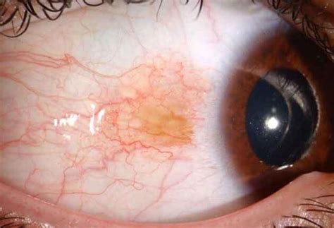 Conjunctival Nevus