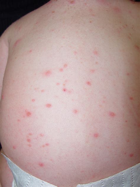 Baby Acne On Back