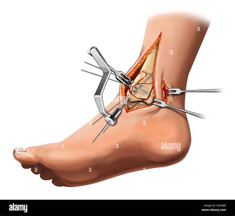 Mediale Malleolar Frakturfixation Stockfotografie - Alamy
