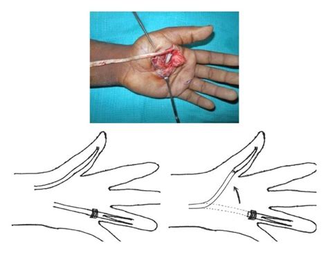 Post-op thumb spica cast applied. | Download Scientific Diagram