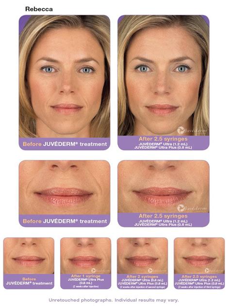 Is Juvederm Ultra Plus Good For Lips | Lipstutorial.org