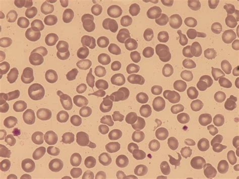 Anisocytosis and anisochromasia