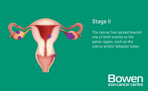 What is Ovarian Cancer? Ovarian Cancer Explained — Bowen Icon Cancer Centre