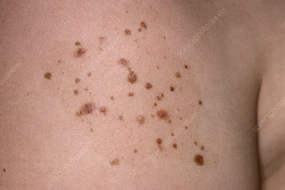 Nevus spilus - Stock Image - C051/6979 - Science Photo Library