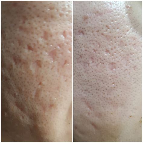 Improvement in pitted scars (Tretinoin, AHA30) : r/tretinoin